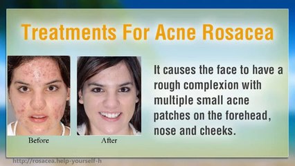 Treatments For Acne Rosacea
