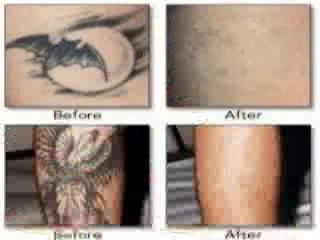 Deshacerse De Los Tatuaje Naturalmente Get Rid Tattoo Spanish