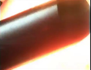 Ellipse treatment of Couperose (Rosacea)