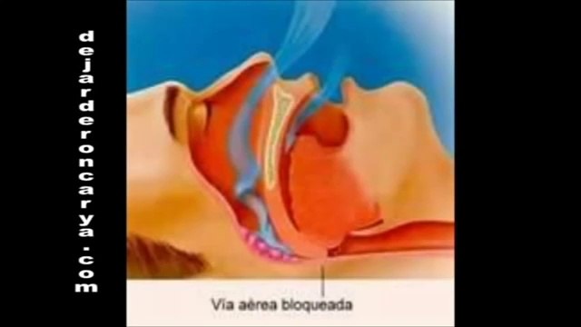 Roncar solución - Dejar de roncar hoy