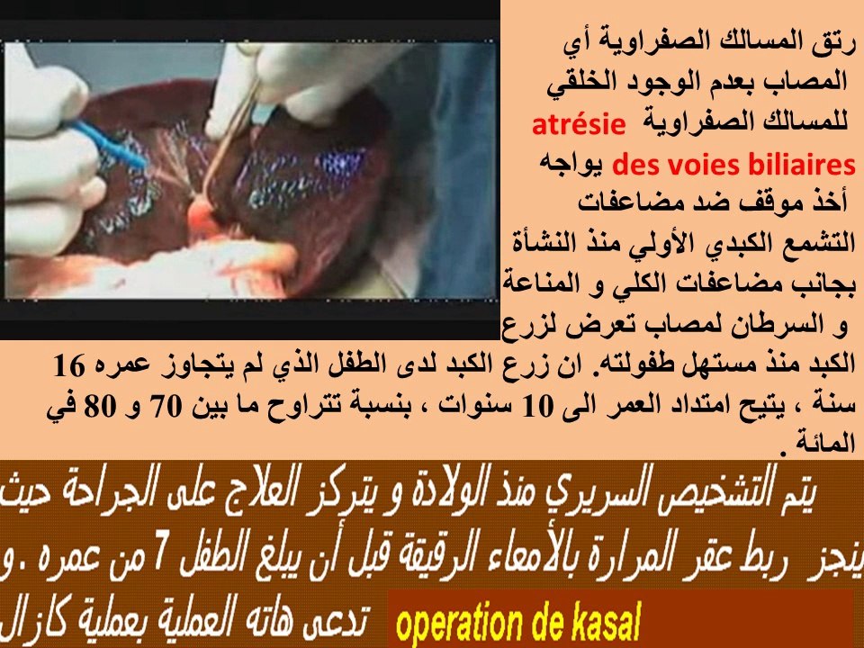 Les principales hépatopathies chroniques chez l'enfant- Hépatites B et C