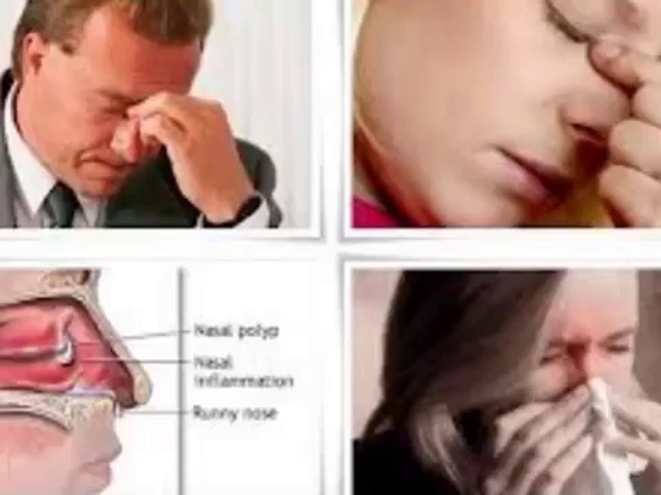 ★ Nasal Polyps Treatment Miracle ► The Natural Cure For Nasal Polyps ★