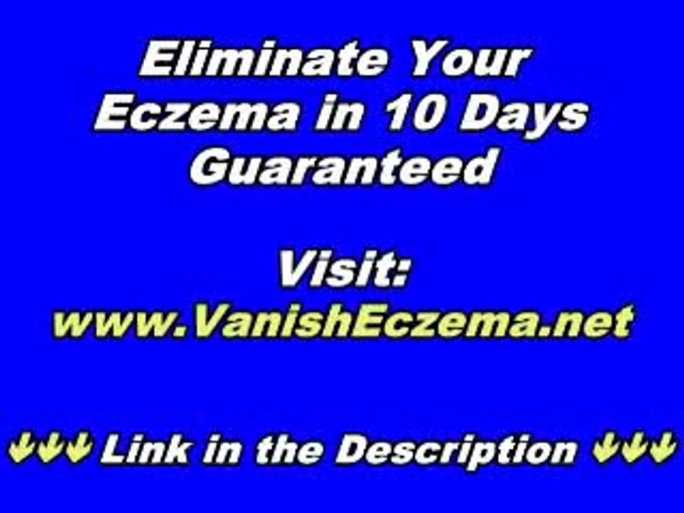 14 Days Eczema Cure Review - Your Ultimate Treatment Plan