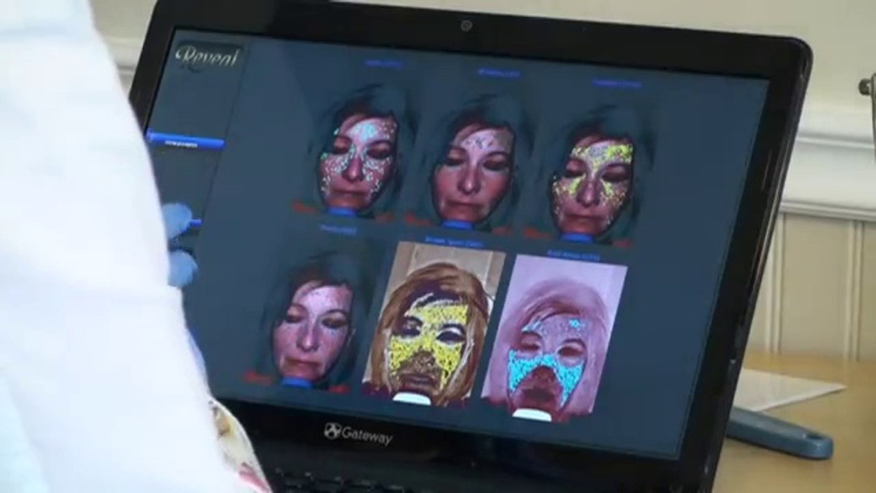 Rosacea Treatment -- Pre Diagnostic -- Longevity Medical Aesthetics -- Vancouver Island