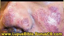 lupus bible - lupus books - thelupusbible - lupus cured - lupus cure treatment
