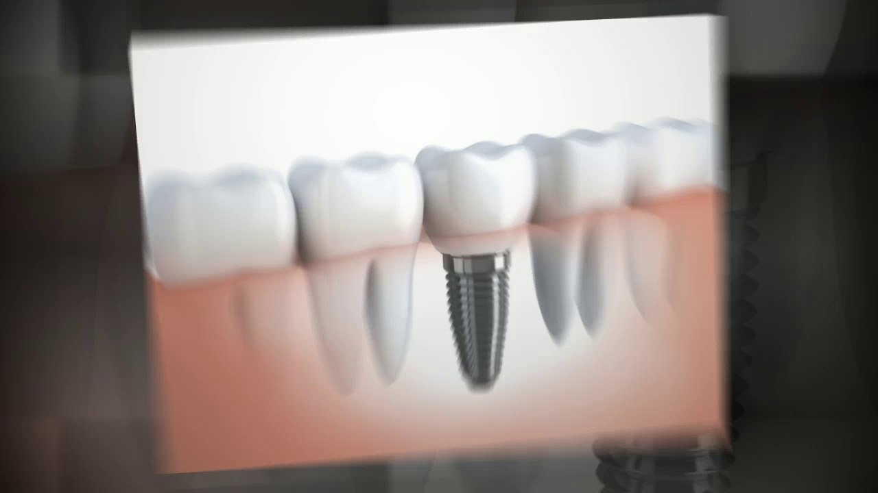 Getting Dental Implants Manchester