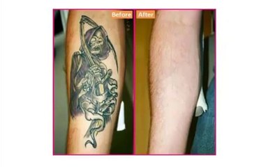 how to remove a tattoo naturally - Get Rid Tattoo
