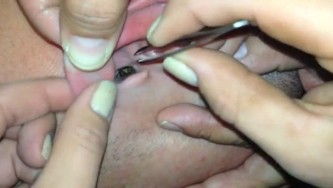 papillon de nuit dans son oreille