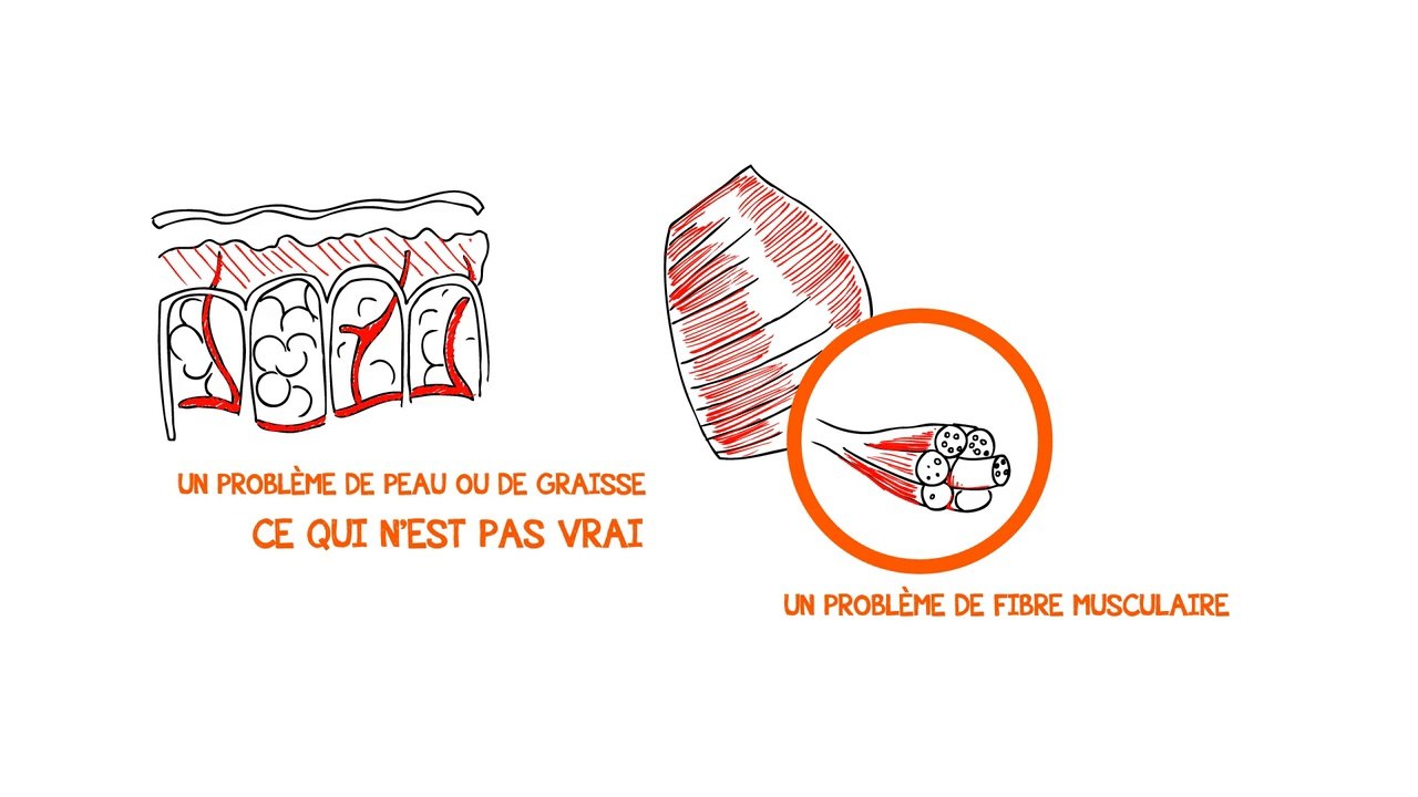 Comment Se Débarrasser De La Cellulite Définitivement Avec Des Méthodes Naturelles