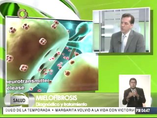 No hay diferencias en la incidencia de mielofibrosis en todo el mundo