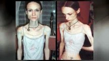 Anorexia. Eating disorders. Binge eating nerviosa. Anorexic treatment and recovery. Bulimia Help