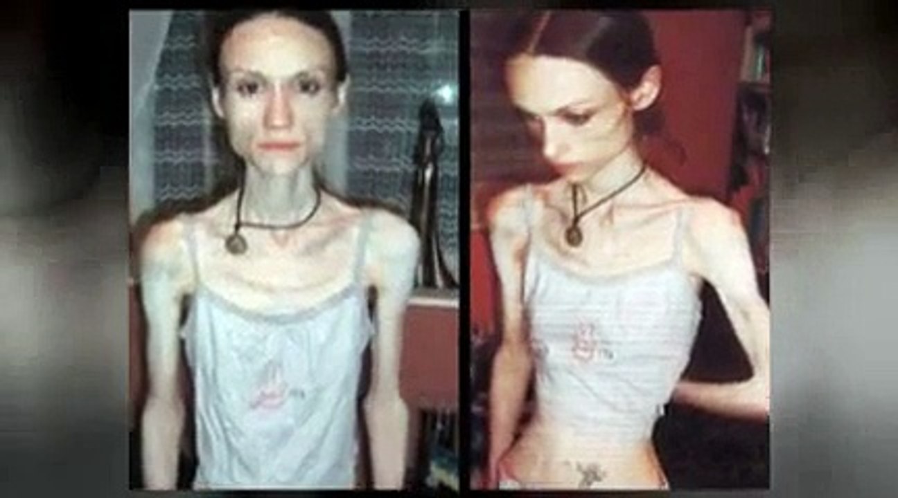 Anorexia. Eating disorders. Binge eating nerviosa. Anorexic treatment and recovery. Bulimia Help