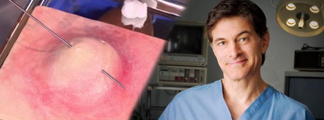 Mehmet Öz'den sivilce önerisi: İğneyle delin