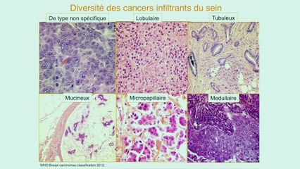 Anne Vincent-Salomon - Que sont les cancers du sein ?
