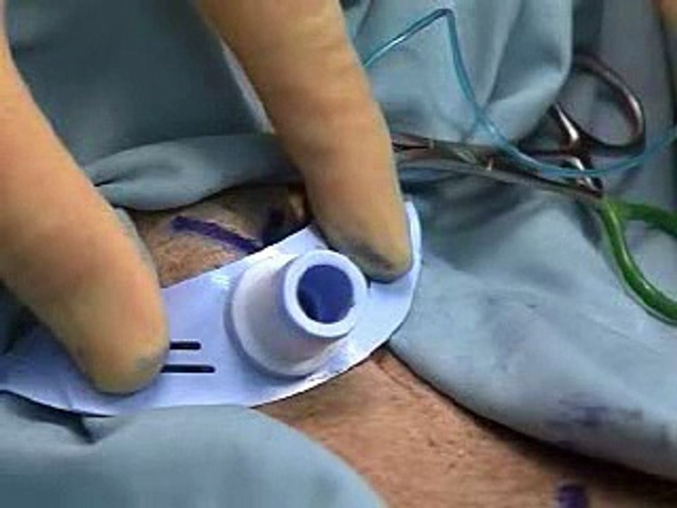 Airway Managment Surgical
