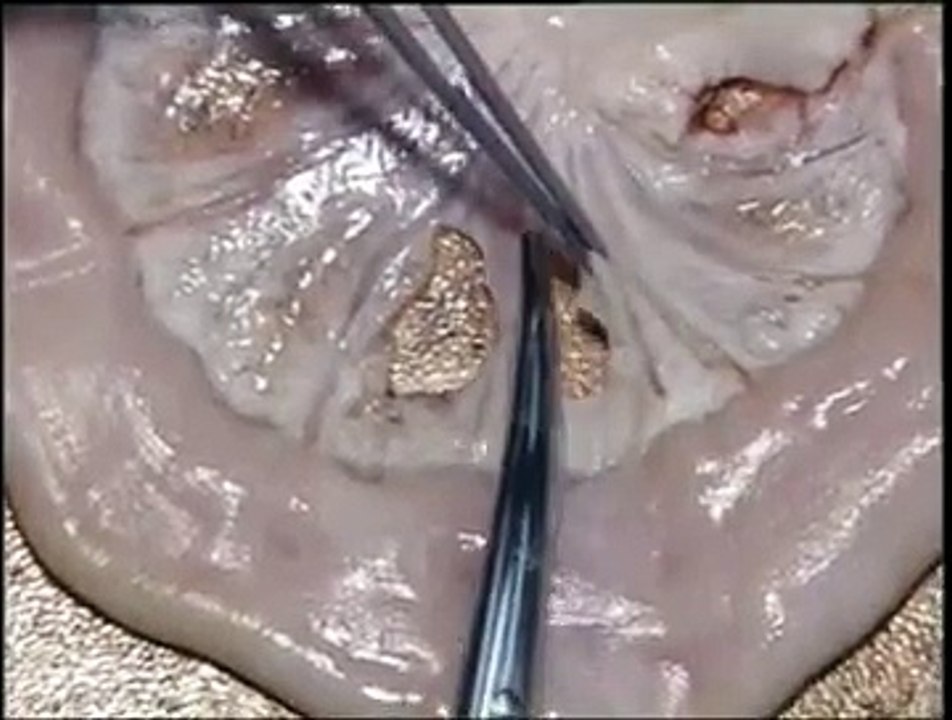 Mesenteric Vessel Ligation