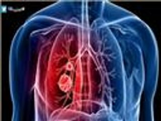 كشف مبكر عن سرطان الرئة عبر فحص الدم