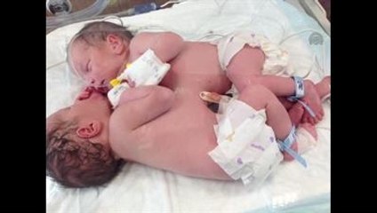 Siyam İkizleri Ameliyatla Ayrıldı