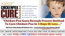 Fast Chicken Pox Cure