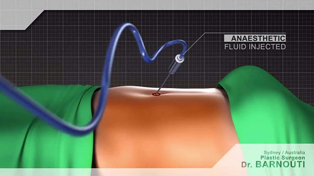 Liposuction Sydney