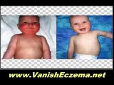 Buy 14 Days Eczema Cure you are looking for