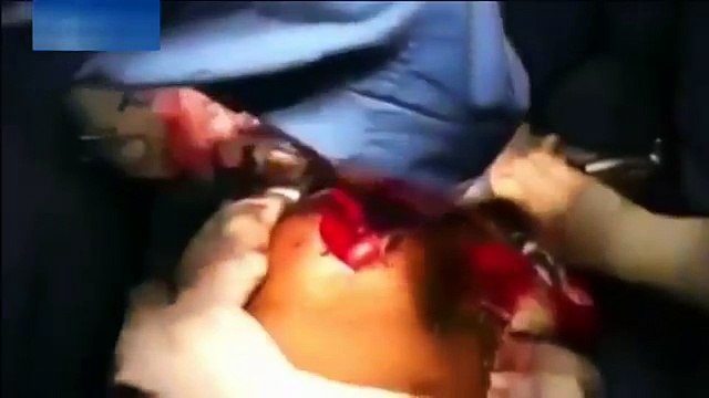 Un poisson vivant retiré des intestins d'un patient au Brésil !