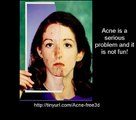 Acne free in 3 Days! -Acne treatments-Acne cure