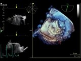 4D TRANSESOPHAGEAL ECHOCARDIOGRAPHY ( 3D TEE ) MITRAL MECHANICAL VALVE