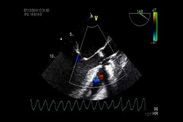 Cardiac arrest VENTRICULAR FIBRILLATION DURING TOE