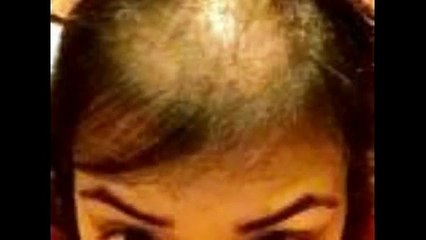 Amazing Hair Transplants