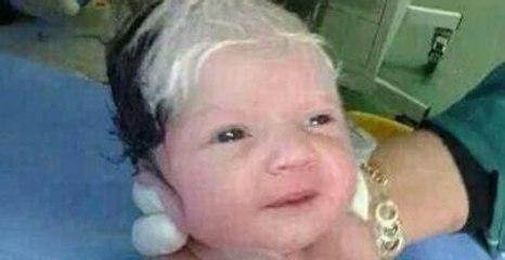 Suriye'de Bir Bebek, Siyah-Beyaz Saçla Doğdu!