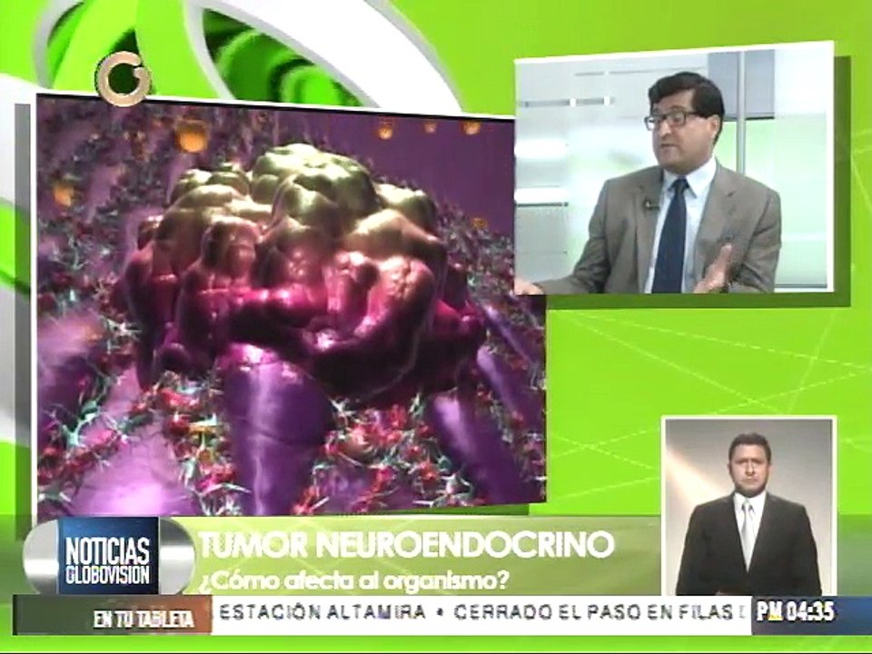 El tumor neuroendocrino más común se presenta en el intestino