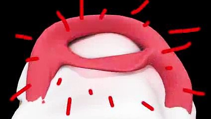 What is a Bucket Handle Meniscus Tear - Orthopedic Surgeon Las Vegas - www.totalSportsMedicine.com