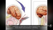 Different Types of Critical Traumatic Brain Injuries