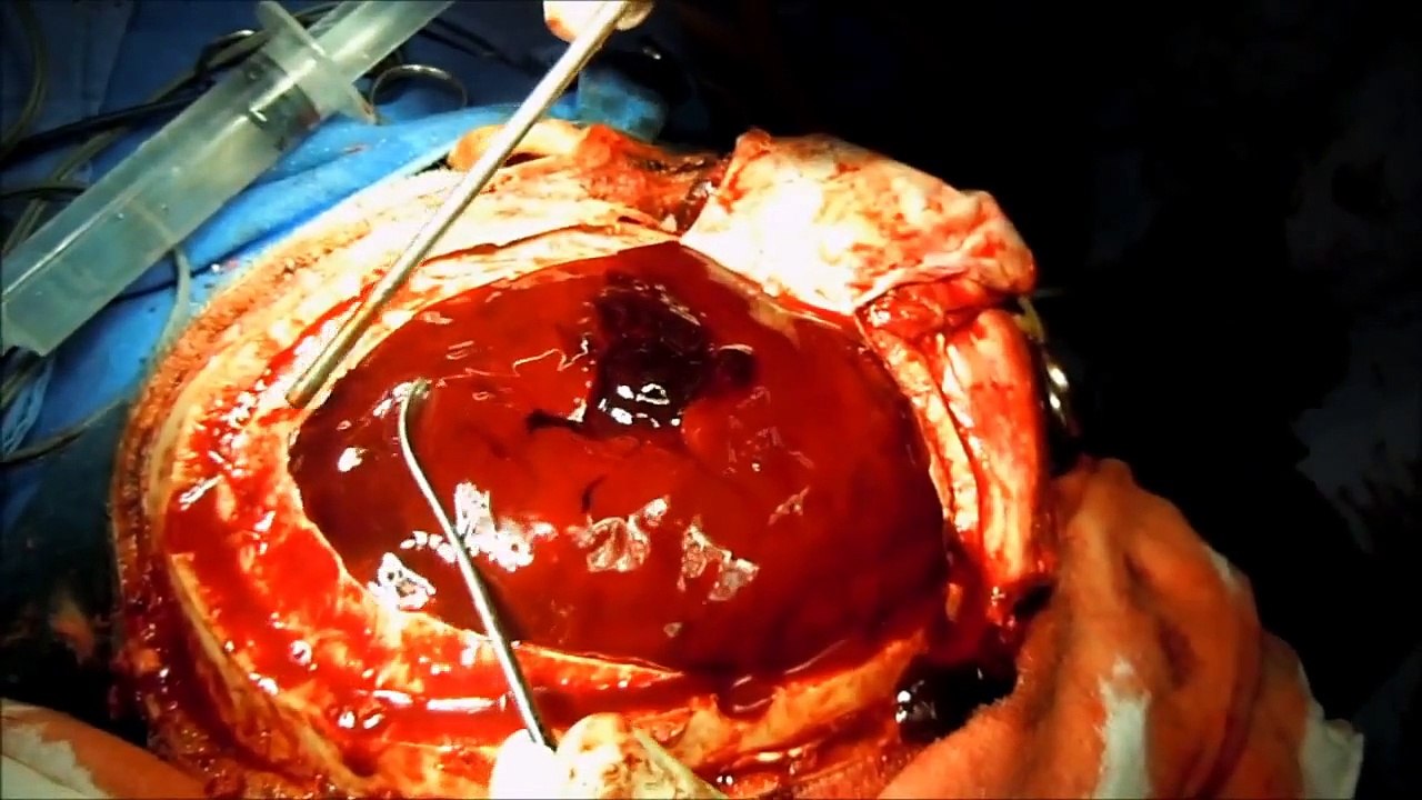 Opération cerveau fascinante : Hématome sous-dural - Vidéo Dailymotion