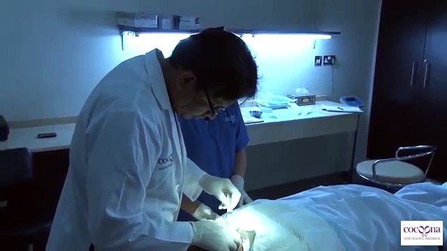 Hair Transplant in Delhi - Cocoona Cosmetic Surgery