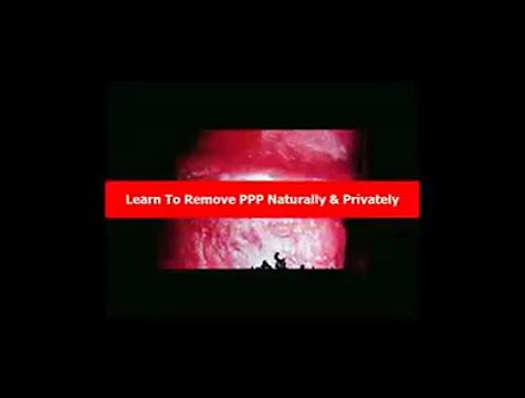 Pearly Penile Papules Removal Houston Pearly Penile Papules Removal Toothpaste