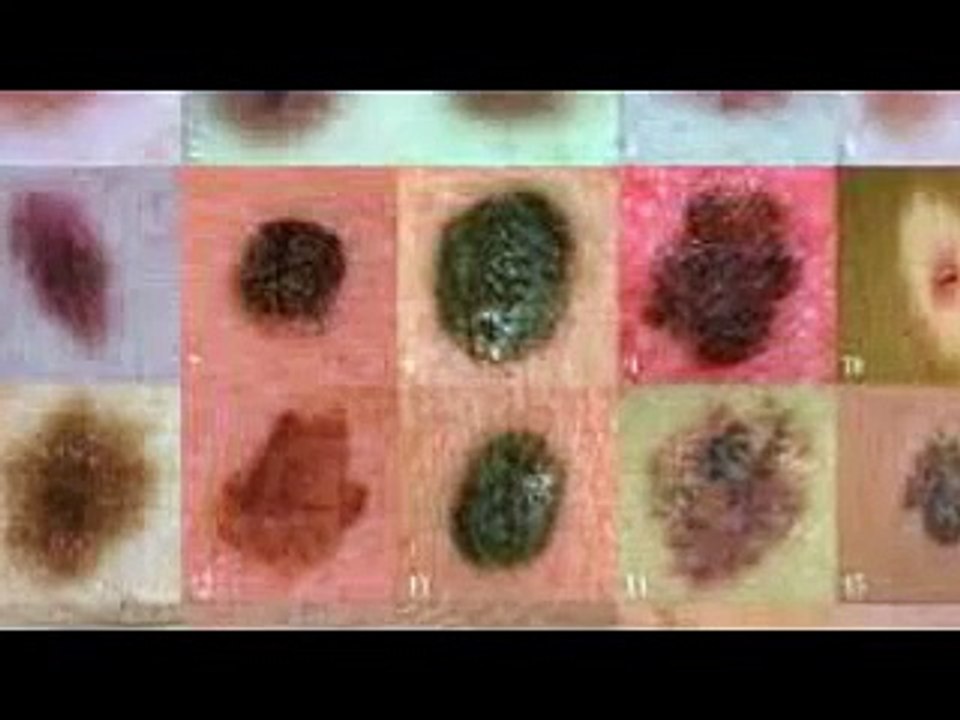 Ung thư hắc tố - Triệu chứng và dấu hiệu