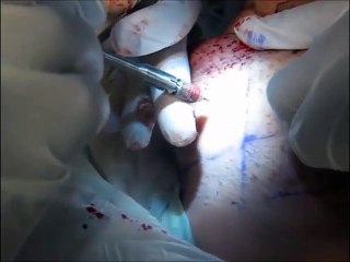 MyWHTC Clinic of Hair loss for Brussels Belgium live surgery patient view