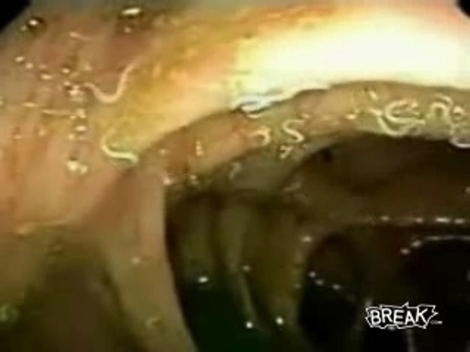 parasite extrem