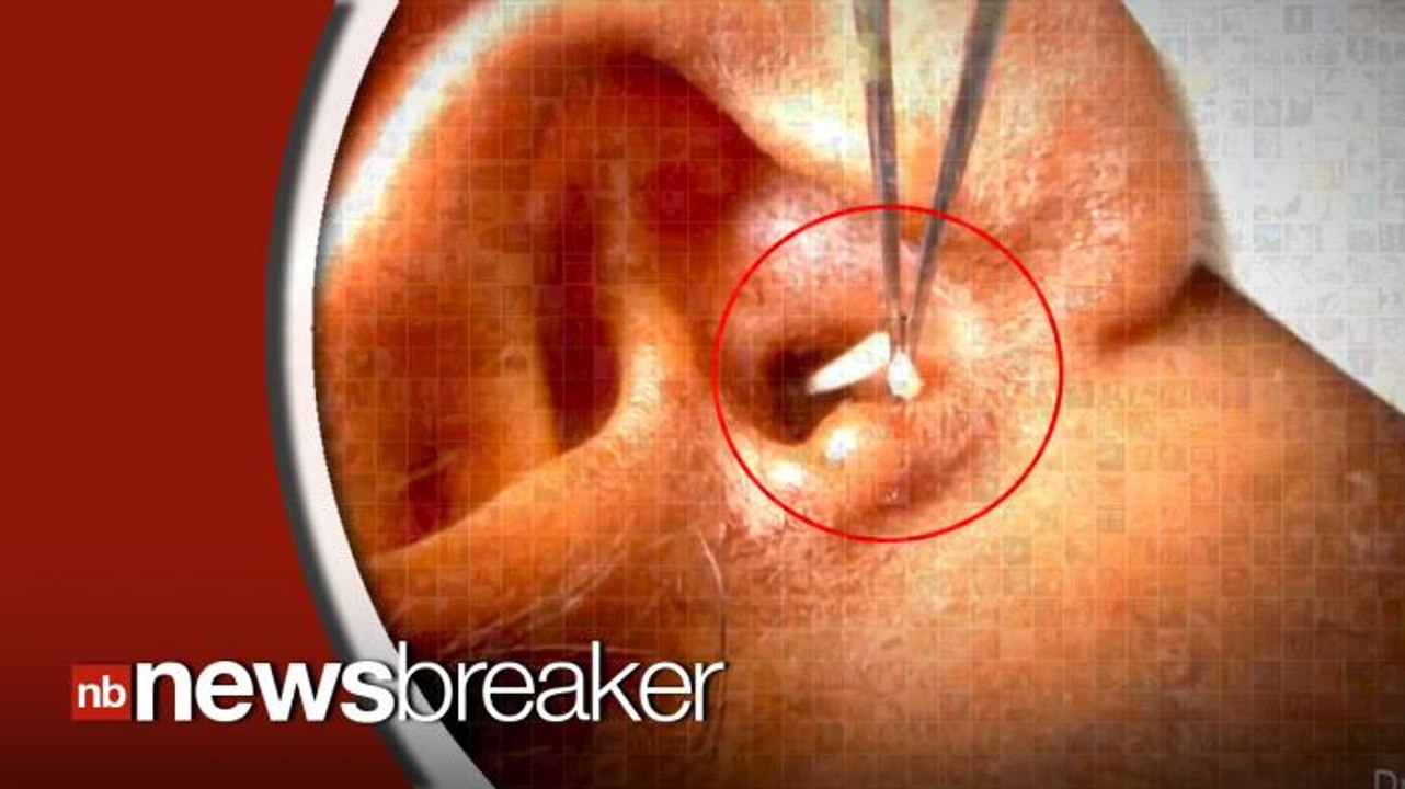 Doctor Removes Maggots from Young Man's Ear in Video