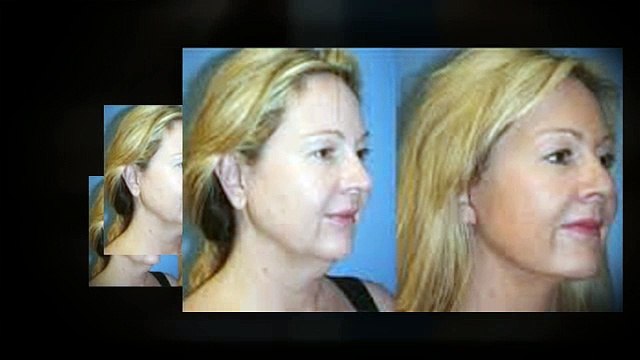 Tummy Tuck Beverly Hills