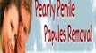 Pearly Penile Papules Removal - natural Ppp Treatment - new Review