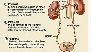 Beat Kidney Disease - Acute Kidney Disease