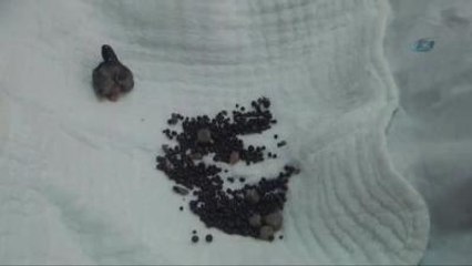 Böbreğinden 794 Adet Taş Çıktı