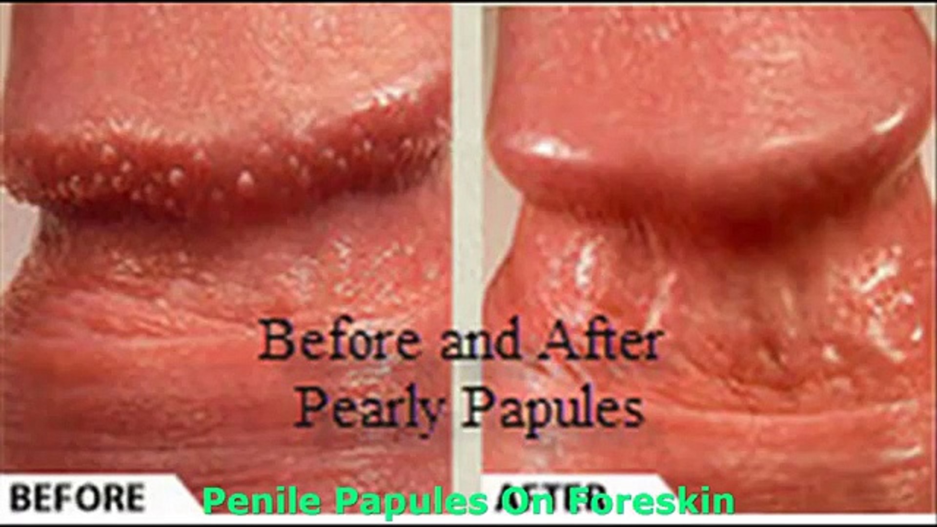 Away go penile pearly papules Pearly papules