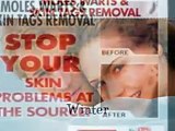 How To Remove Moles Warts And Skin Tags Removal