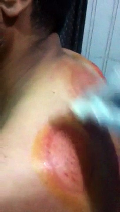 Hijama treatment