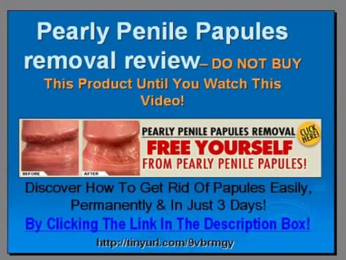 Are papules what penile Hirsuties coronae