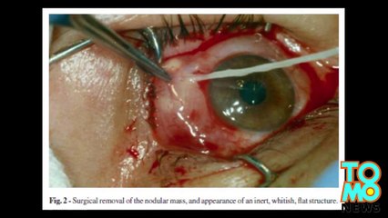 Un patient anglais a vécu 4 ans avec un ver dans le cerveau !